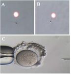 Figure 7. A) Before LAISS procedure; B) After LAISS procedure; C) ICSI procedure. Note that the spermatozoon&rsquo;s tail is curled after LAISS, indicating a viable state of spermatozoon
