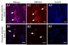 Figure 1. Immunohistochemical analysis of two abnormal human testicular tissues from infertile men. Low basal and high luminal DDX4 expression in case 1 (Merge, A1) and moderate expression in case 2 in luminal cells (Merge, B1). Dapi=blue nuclear staining (A3, B3)