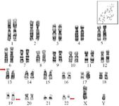 Figure 2. Karyotype analysis: GTG-banded chromosomal analysis of the proband, which reveals the presence of a balanced translocation involving chromosome 19 and 22 along with chromosome 13 ps+.