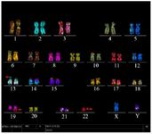 Figure 3. Multicolor fluorescence in situ hybridization (mFISH): A stable balanced chromosomal translocation in the proband, detected by mFISH. Chromosomes involved in this translocation are indicated by arrows; a balanced chromosomal translocation is shown involving two chromosomes 19 and 22