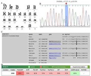 Figure 2. A) Representative karyotype (46,XX) of case 1, B) Electropherogram of the c.975T&gt;A (p.I310N), C) The multiple sequence alignment of the p.I310N mutant protein reveals the conservation of isoleucine at this position throughout evolution, D) In silico prediction of both variants using prediction tools of SIFT, SNAP, Polyphen-1, Polyphen-2, PhD-SNP, MAPP, and PredictSNP
