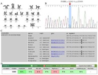 Figure 3. A) Representative karyotype (46,XX) of the second case, B) Electropherogram of the c.1156G&gt;A (p.D386N), C) The multiple sequence alignment of the p.D386N mutant protein reveals the conservation of isoleucine at this position throughout evolution, D) In silico prediction of both variants using prediction tools of SIFT, SNAP, Polyphen-1, Polyphen-2, PhD-SNP, MAPP, and PredictSNP
