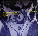 Figure 1. Pelvis coronal view by MRI showing the left testis with uterus continuing as cervix and upper vagina