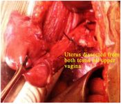 Figure 2. Intraoperative image showing dissected uterus from both testicles till upper vagina