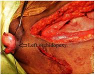 Figure 4. Intraoperative image showing left orchidopexy