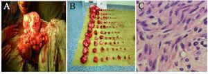 Figure 1. A) Subserosal multiple fibroids in a woman. B) Multiple fibroids (n=84) surgically removed by minimally invasive low transverse mini laparotomy. C) Transverse section leiomyoma