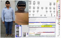 Figurer 1. A, B) Patient with Kallmann syndrome, C) Mild ichthyosiform lesion in the abdomen, D) Karyotype report of the patient showing extra material on p arm of chromosome X, E) Cytogenetic microarray of the patient showing complete deletion of STS gene and partial deletion of ANOS1 (KAL1) gene, respectively, F) Ideograms of chromosomes X and Y showing deleted (Red inverted triangle) and duplicated segments (Blue triangle) on chromosomes X and Y, G) Diagrammatic representation of breakpoint on X chromosomes showing deletions of exons 7-14 of ANOS1 gene
