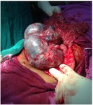 Figure 1. Gross appreance of pure malignant germ cell tumor of the ovary (endodermal sinus tumor)