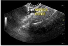 Figure 1. Transvaginal ultrasound guided intrafetal injection of KCL and methotrexate instillation