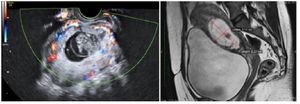 Figure 3. Color Doppler showing increased vascularity and MRI film showing anterior myometrial thickness &lt;2 mm
