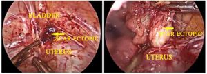 Figure 4. Laparoscopic excision of caesarean scar ectopic pregnancy