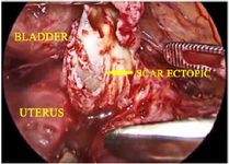 Figure 6. Laparoscopic excision of 3cm caesarean scar ectopic mass