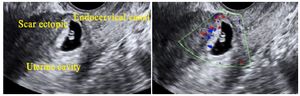 Figure 7. Ultrasound showing empty uterine cavity and endocervical canal. Ectopic pregnancy seen at the level of previous caesarean scar. Doppler study shows increased vascularity