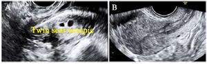Figure 8. A) Twin scar ectopic pregnancy. B) Complete resolution of scar ectopic mass on follow up scan