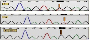 Figure 2. Parents (F and M) whole exome sequencing (WES) indicating heterozygous USP18(+) Exon 9 c.906 T&gt;G (p.Tyr 302 Ter) and fetal WES indicating homozygous USP18(+) Exon 9 c.906 T&gt;G (p.Tyr302 Ter)
