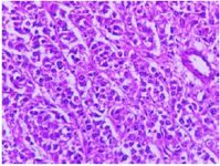 Figure 2. Larger view of multidimensional cells with clear cytoplasm, same-sized nucleus, and low atypia in dense groups
