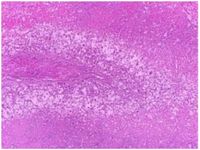 Figure 5. Immunohistochemistry with HBM45 marker
