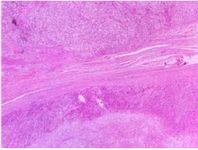 Figure 6. Immunohistochemistry with Melan A marker
