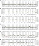 Figure 2. PGT-SR results: A) positive for heterozygous ~6 Mb deletion at 12 p13.33p13.31, trisomy 15; B) positive for heterozygous ~4 Mb deletion at 6 p25.3p25.2, positive for heterozygous ~4 Mb duplication at 12 p13.33p13.31, trisomy 15; C) positive for heterozygous ~4 Mb deletion at 6 p25.3p25.2, positive for heterozygous ~45 Mb duplication at 2p25.3p21, monosomy; 22 D) positive for heterozygous ~4 Mb deletion at 6 p25.3p25.2, positive for heterozygous ~45 Mb duplication at 2p25.3p21, trisomy; 16 E) chaotic (multiple aneuploidies); and F) chaotic (multiple aneuploidies)