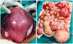 Figure 2. A) Intraoperative image showing grossly enlarged uterus with multiple fibroids. B) Removal of 75 fibroids
