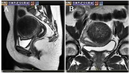 Figure 3. A) Sagittal T2 w image showing a single fibroid in the left posterolateral wall of uterus. B) Axial T2w image showing large fibroids in posterolateral wall
