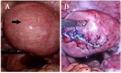 Figure 4. A) Laproscopic view showing a large fibroid in the left posterolateral wall of uterus (black arrow). B) Laparos-copic view showing stitched uterus following myomectomy
