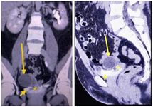 Figure 1. CECT of the abdomen and pelvis showing contrast extravasation from the left side of the posterior wall of urinary bladder (short arrow) into the vaginal vault of tract with intravesical fimbrial herniation (asterisk) and a right ovarian cyst (long arrow), stuck to sutured vaginal vaul