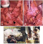 Figure 2. Image showing (A) right ovarian cyst (long arrow) densely adhered near the left vaginal vault apex located near the VVF site (arrow head) with right fimbrial herniation (asterisk) into the bladder (short arrow) through the VVF tract, (B) bladder (short arrow) and vaginal end (long arrow), post right salpingo-oophorectomy [Cystoscopic view showing papillary frond like mass (asterisk) protruding intravesically (arrow) from VVF site (arrow head)], (C) gross specimen of serous cystadenoma of the right ovary with fimbria