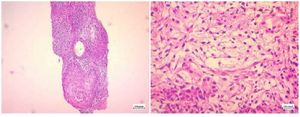 Figure 1. Histologic examination before second-look surgery consistent with the diagnosis of immature teratoma
