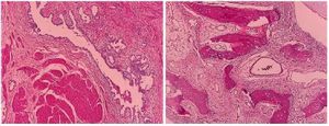Figure 2. Histologic examination after the second-look surgery consistent with the diagnosis of mature teratoma