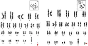 Figure 1. Image of karyotype analysis indicating loss of chromosome Y (left) along with partial deletion of Y chromosome (right)
