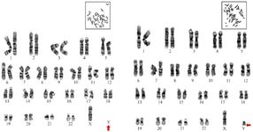 Figure 1. Image of karyotype analysis indicating loss of chromosome Y (left) along with partial deletion of Y chromosome (right)
