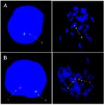 Figure 2. Fluorescence in-situ hybridization: Image A, showing loss of chromosome Y(XO) and image B is showing presence of both sex chromosomes (XY)
