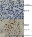 Figure 3. Photomicrograph depicting immunostaining of peri-implantation endometrium from fertile control women and women with RIF. CD 56 (brown stain) in normal endometrium (A) CD 56 (brown stain) in endometrium from RIF woman (B). IHC (200X)
