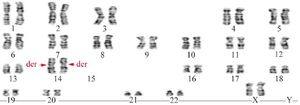 Figure 2. A karyotype image of fetal cells obtained through amniocentesis fluid revealed a chromosomal makeup of 44,XX,rob (14;15)&times;2
