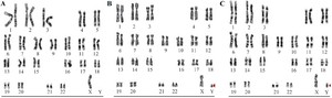 Figure 1. Male karyotype analysis showing the distribution of cell lines observed in a total of 50 cells. Cell line A exhibits 45,X in 44 cells, cell line B shows 46,XY in 5 cells, and cell line C displays 46,X,idic(Yp) in 1 cell