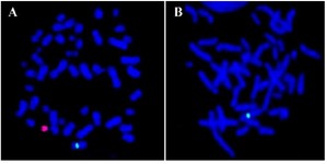 Figure 2. A) Metaphase showing one green signal for X chromosome and one red signal for Y chromosome, B) Metaphase showing one green signal for chromosome X