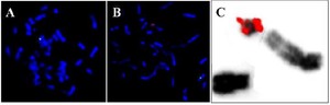 Figure 3. LSI SRY(red)/CEPX(green); A) 45,X cell line with only one green signal for X chromosome; B) 46,X,idic(Yp) cell line with one green signal for X chromosome and two red signals for SRY on the abnormal Y chromosome; C) inverted DAPI image showing two signals for SRY on idic(Yp)