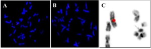 Figure 4. SE X (DXZ1-red)/SE Y (DYZ1-green); A) 45,X cell line with only one red signal for X chromosome; B) 46,X,idic(Yp) cell line with one red signal for X chromosome and no green signals for Yq12 heterochromatin region on the abnormal Y chromosome; C) inverted DAPI image showing suspected&nbsp; idic (Yp) without any signals for Yq12 heterochromatin