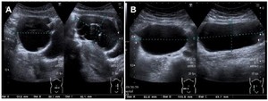 Figure 1. Transvaginal ultrasound images from the first visit demonstrating an 8.1&times;6&times;4.6 cm complex cystic structure in the midline of the pelvis (A) and a second cyst measuring 12&times;8.3&times;5 cm to the right of the midline (B)