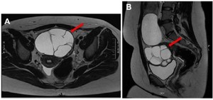 Figure 2. T2-weighted magnetic resonance imaging demonstrating a transverse view (A) and a sagittal view (B) of a multiloculated left ovarian cyst measuring 7.3&times;8&times;8 cm with thin septations distributed throughout