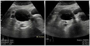 Figure 3. Transvaginal ultrasound images from second visit demonstrating a 5.4 cm right ovarian cyst containing loculations and some solid areas