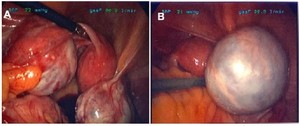 Figure 4. A laparoscopic view of bilateral ovarian cysts at second recurrence (A) with a 6 cm right benign mucinous cystadenoma (B)