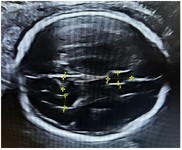Figure 2. Transventricular plane showing measurement of (1) ventricular diameter, (2) POF, and (3) CSPW