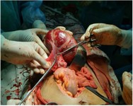 Figure 1. Intraoperative view of the tubal mass, clinically palpable and initially mistaken for a uterine pregnancy
