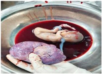 Figure 2. Cross-section of the excised tubal mass revealing a 419 g fetus with attached placenta