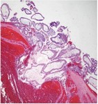 Figure 3. Histopathological section demonstrating chorionic villi consistent with ectopic pregnancy