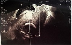 Figure 1. Ultrasonographic image at 18 weeks of gestation showing a complete placenta previa with thinning of the myometrium between the placenta and the bladder, indicating placenta previa