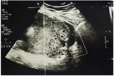 Figure 2. Ultrasound image demonstrating loss of interface between the myometrium and placenta, with increased vascularity behind the placenta and presence of multiple placental lakes, consistent with placenta percreta