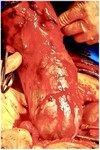 Figure 3. Intraoperative photograph showing placental infiltration into the uterine wall and bulging of the anterior surface, consistent with placenta percreta